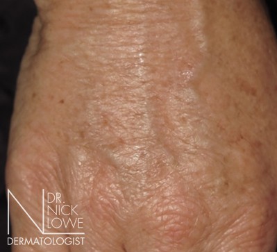 After 1ML Polycaprolone Beads in Carbethoxycellulose Injections