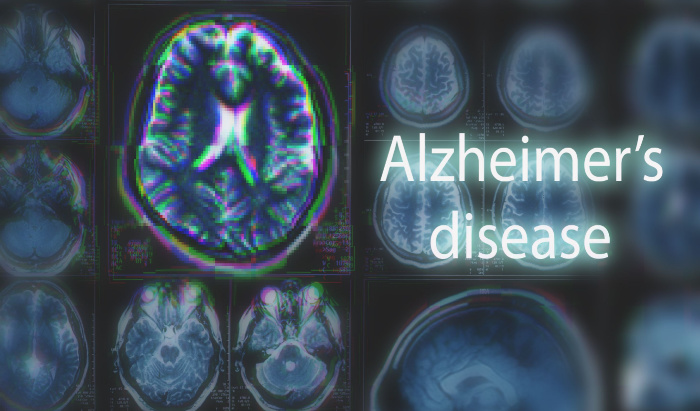 Alzheimer’s