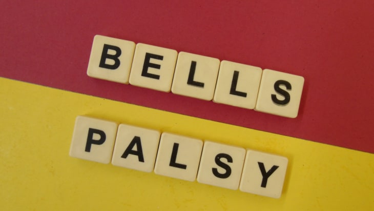 Bell's palsy