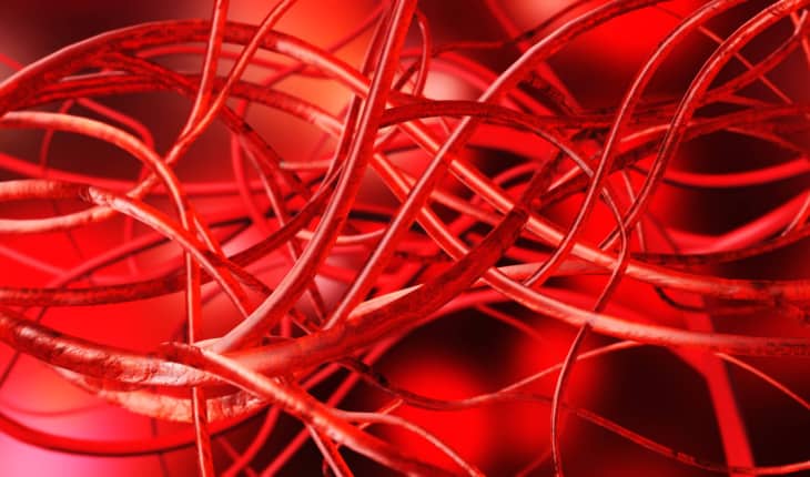 atherosclerosis progression