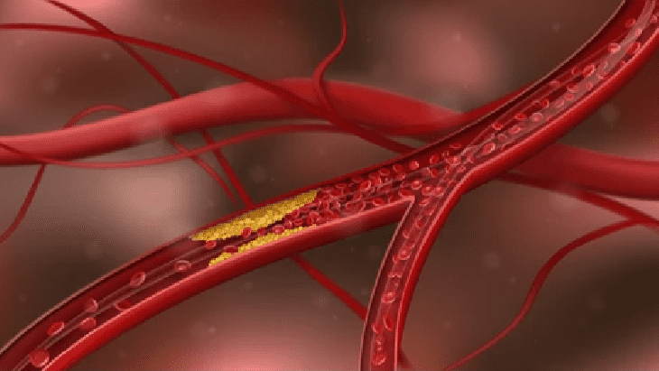 Atherosclerosis