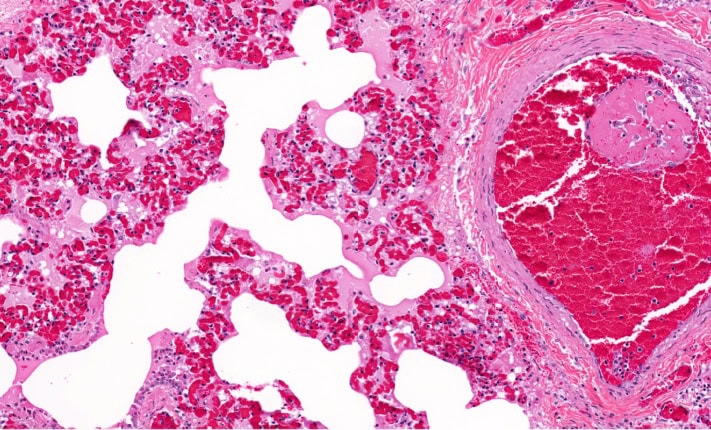 thromboembolism in children