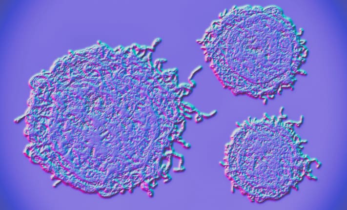 Neuroendocrine prostate cancer