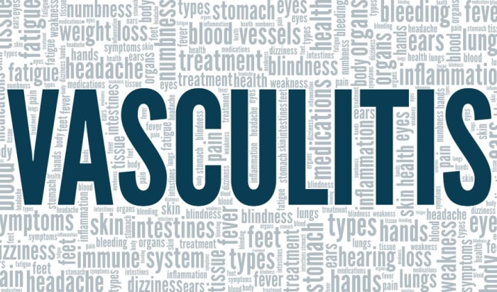 vasculitis