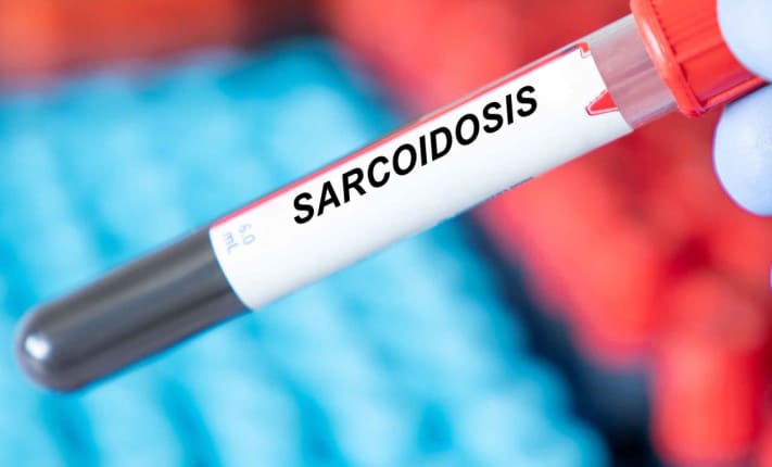 sarcoidosis