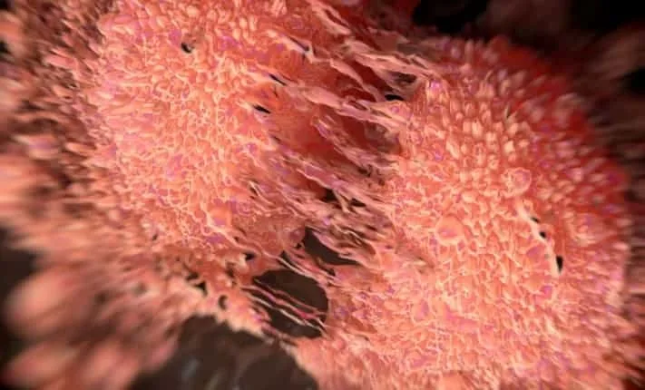 drug-resistant prostate cancer