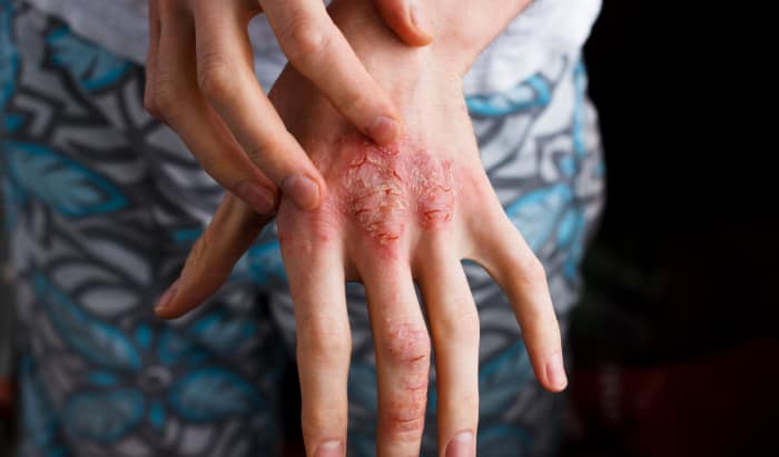 dermatitis