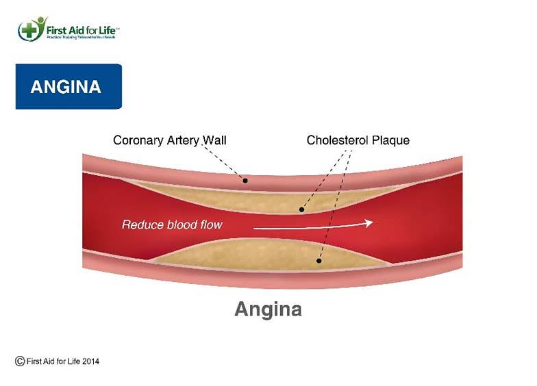 angina
