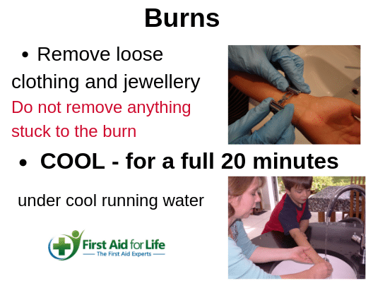 First Aid for Burns - how to reduce pain and scarring