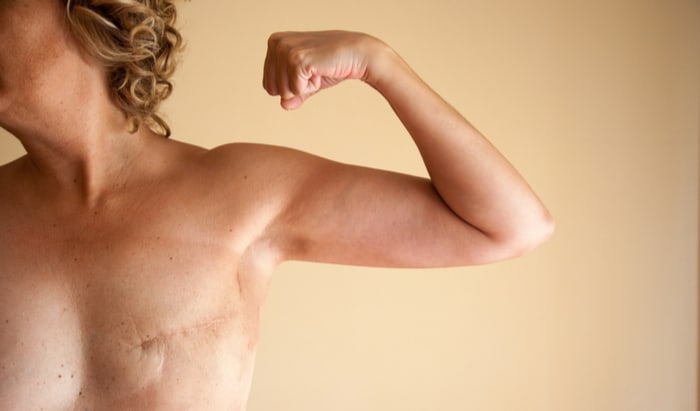 individualising radiotherapy