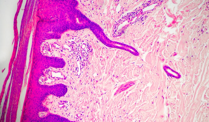 development of psoriasis