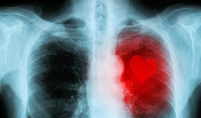 cardiovascular disease